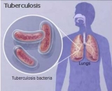 Туберкулез