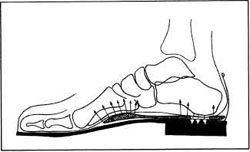 Принцип действия супинированной стельки: схема расположения стельки в обуви 
